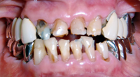 高崎　酸蝕歯
