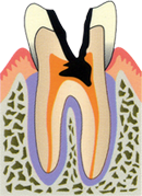 高崎市　虫歯