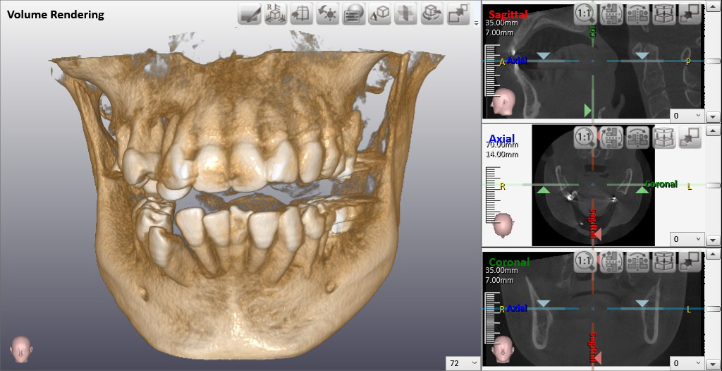 歯科用CT検査　高崎