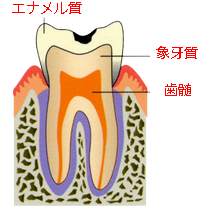 高崎　虫歯