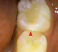 高崎　初期虫歯