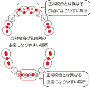 虫歯　高崎市