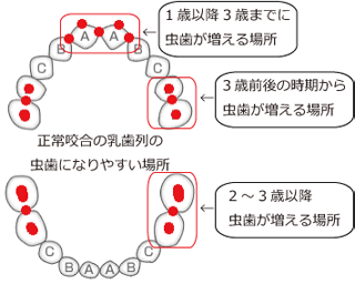 高崎市　虫歯