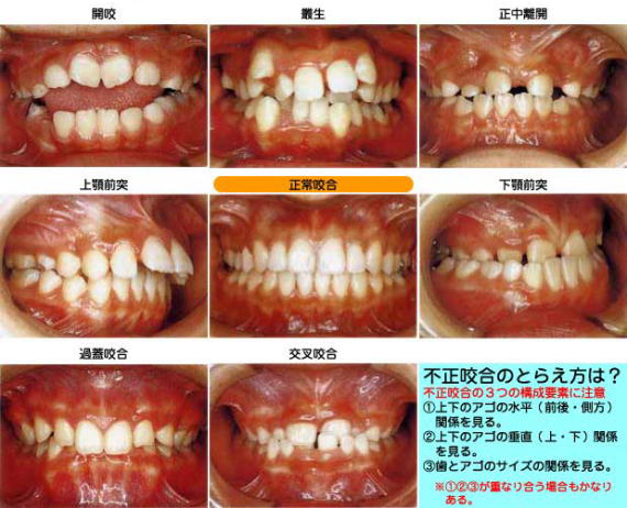 高崎　咬合の健康診断