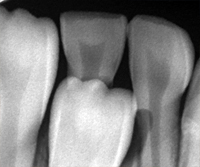 歯科　デジタルレントゲン
