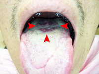 高崎　正中菱形舌炎