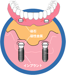 高崎　インプラント　マグネット