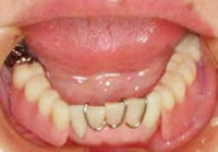高崎　磁石式義歯