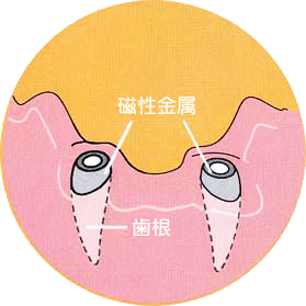 磁石入れ歯　高崎