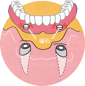 高崎市　磁石入れ歯