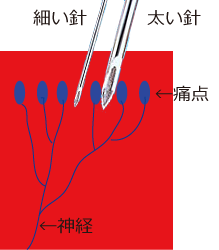 微痛治療　高崎