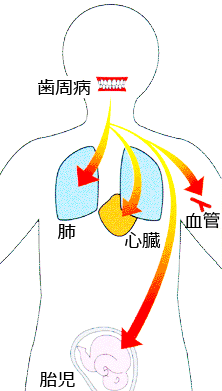 高崎　歯周病が全身に及ぼす影響