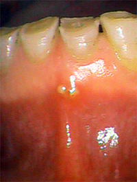 歯根嚢胞　高崎市
