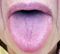 高崎　舌痛症